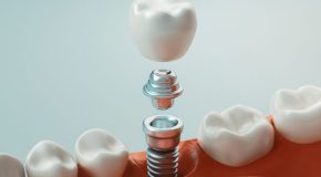 Soins dentaires – Vers un remboursement des implants ?