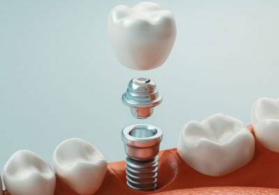 Soins dentaires – Vers un remboursement des implants ?